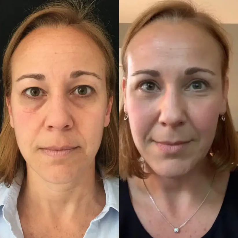 Eye therapy- eye care