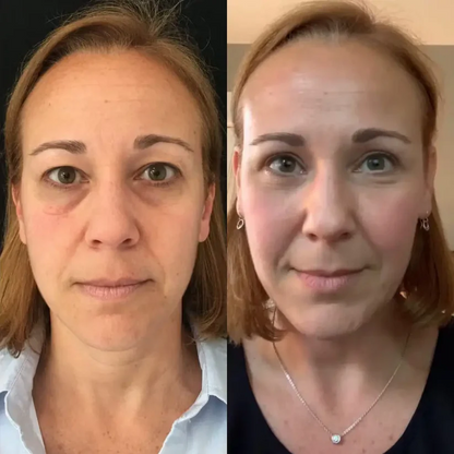 Eye therapy- eye care